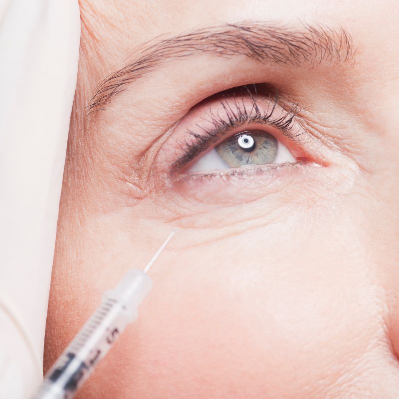 PRFM Under Eye | The Treatment | Available in Newport Beach, San Clemente, Claremont, Redlands, and Henderson